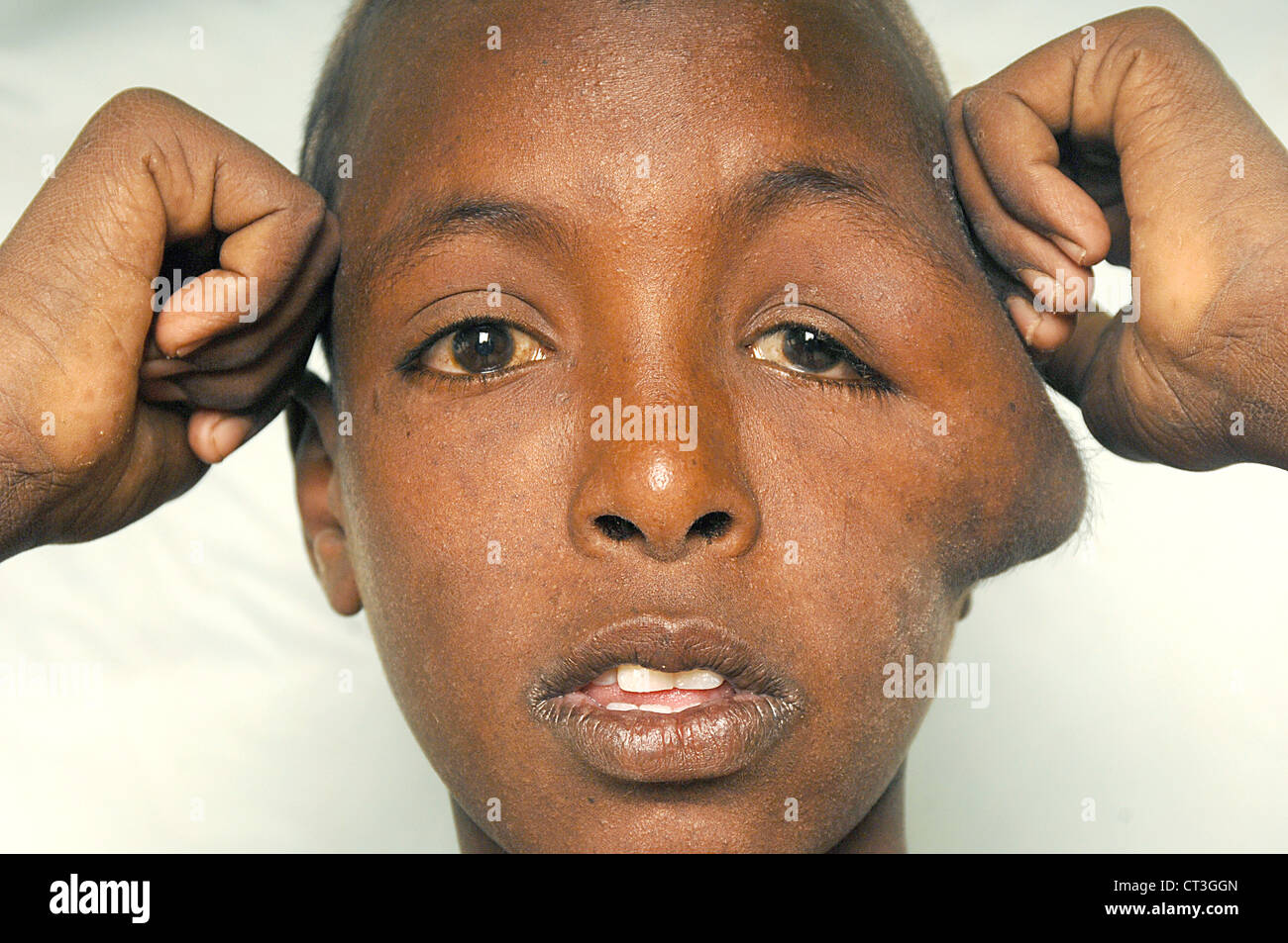 13 Jahre alte männliche Neuro Hämangiom und Tinea Capitis - Soba, Sudan leiden. Tinea Capitis ist besser bekannt als Scherpilzflechte in der Kopfhaut. Stockfoto