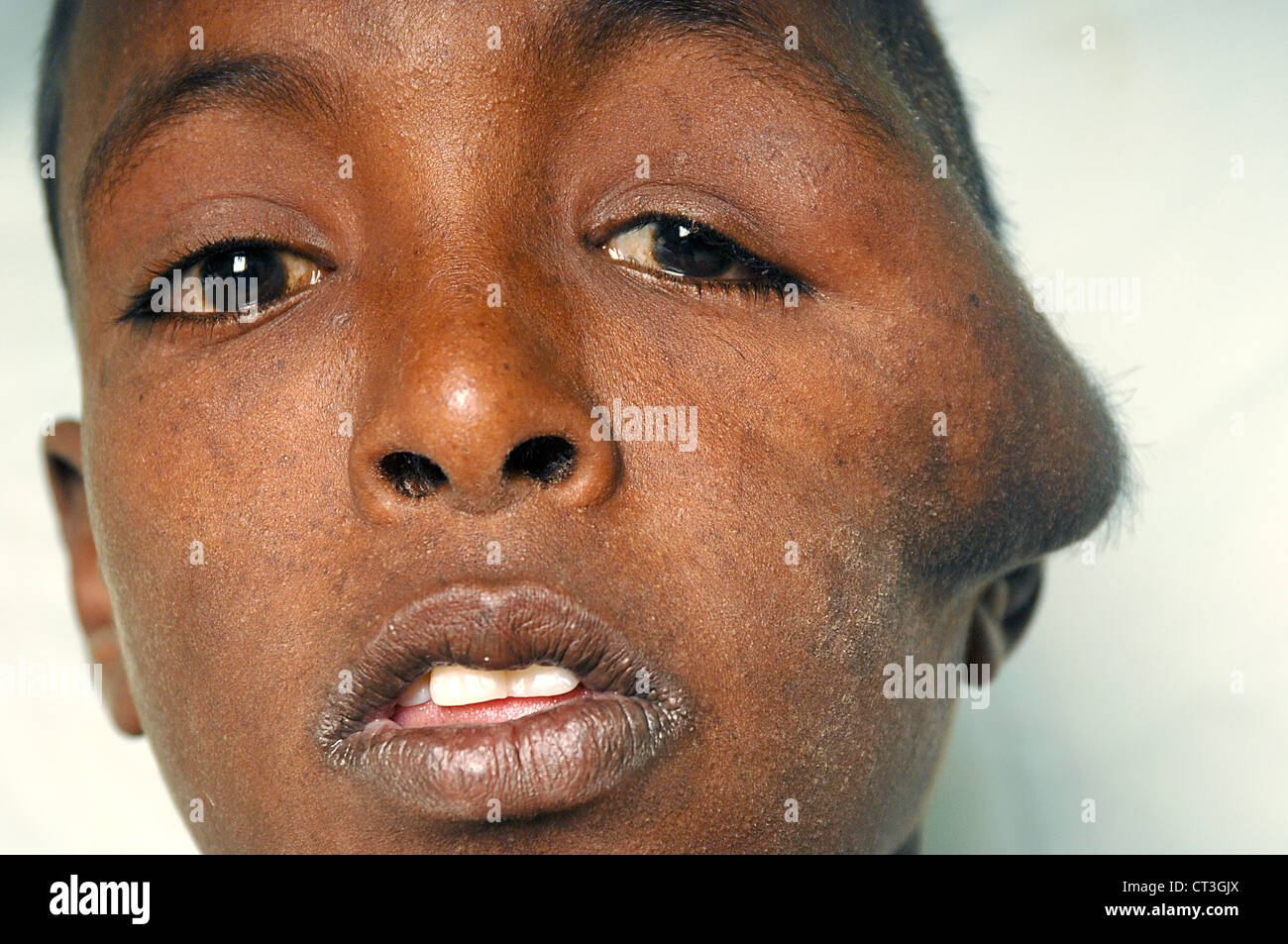 13 Jahre alte männliche Neuro Hämangiom und Tinea Capitis - Soba, Sudan leiden. Tinea Capitis ist besser bekannt als Scherpilzflechte in der Kopfhaut. Stockfoto