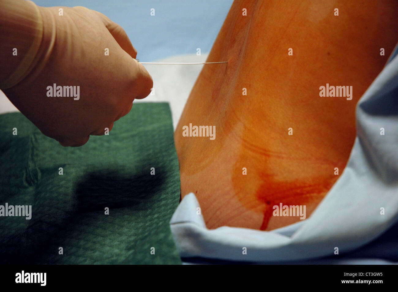 SPINAL TAP Stockfoto