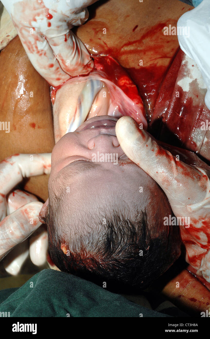 Ein Neugeborenes. Kaiserschnitt Stockfoto