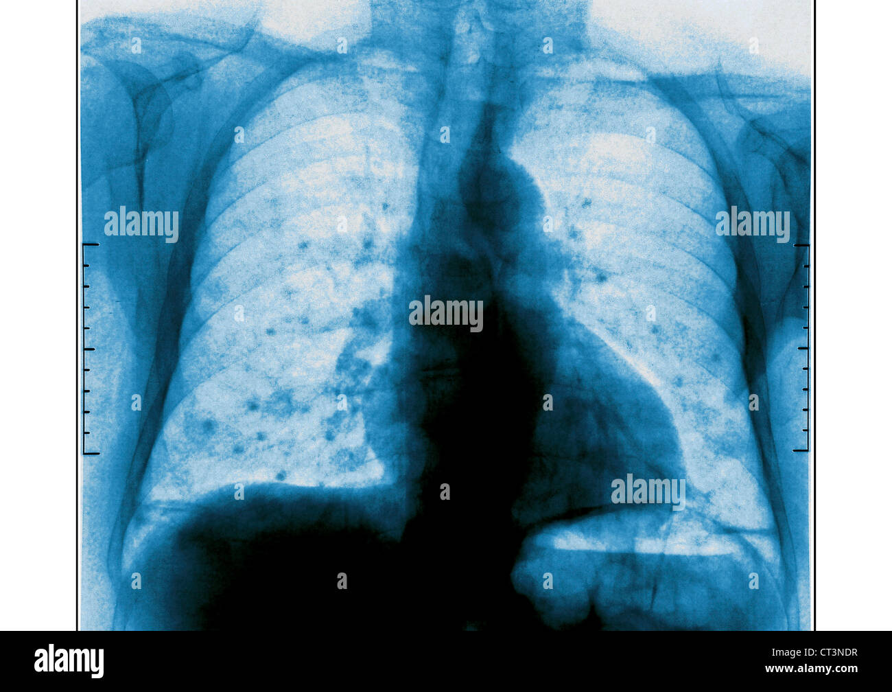 LUNGENKREBS METASTASEN, XRAY Stockfoto, Bild 49255187 Alamy