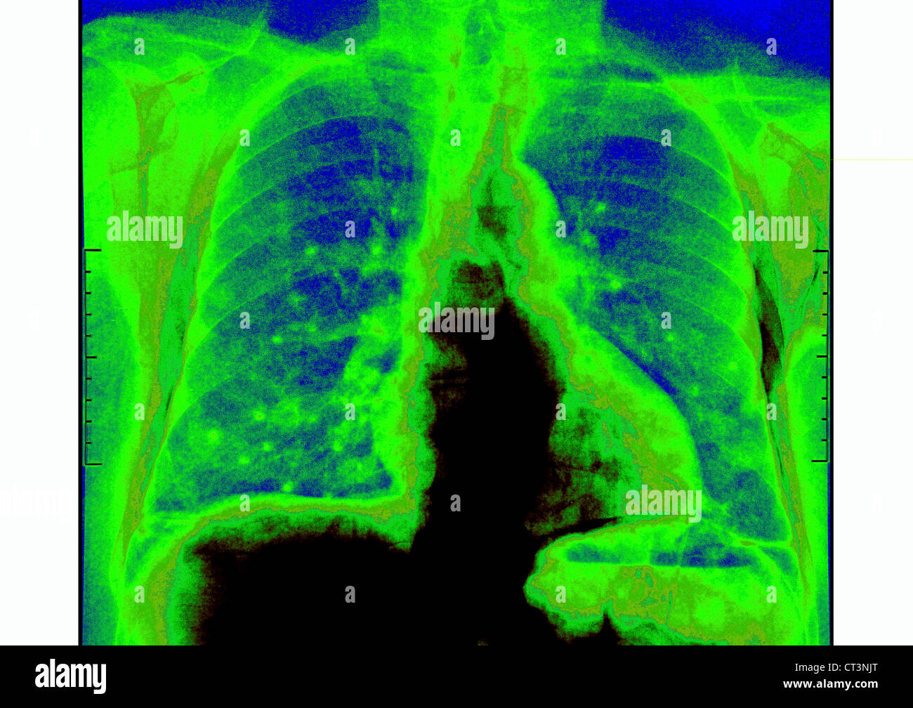 LUNGENKREBS METASTASEN, X-RAY Stockfotografie - Alamy