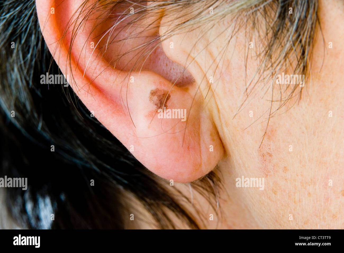 DERMATOLOGIE, BEHANDLUNG VON ÄLTEREN P. Stockfoto