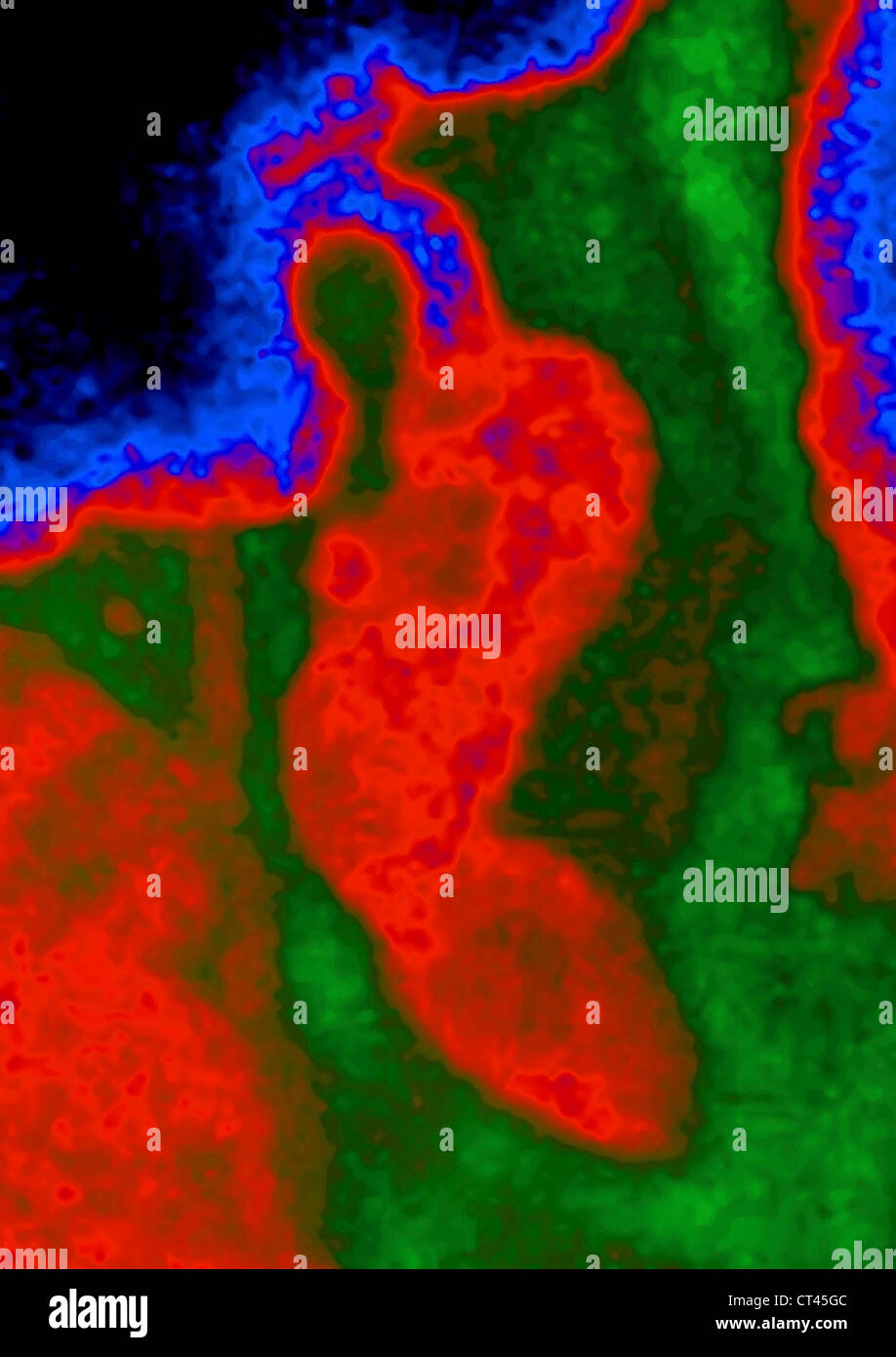 BLINDDARMENTZÜNDUNG, X-RAY Stockfoto