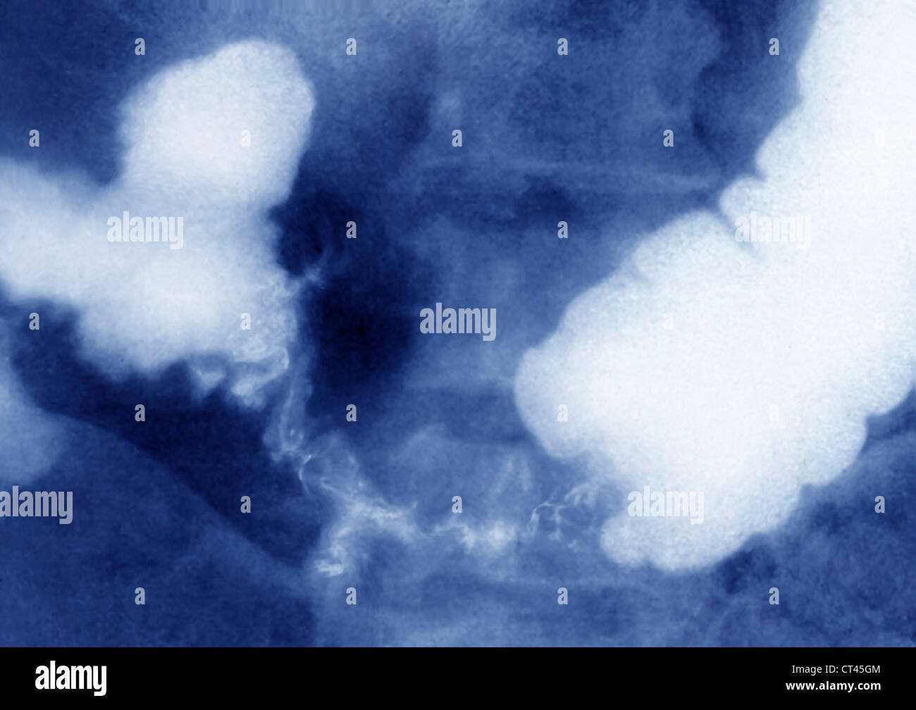 KOLONKARZINOM, X-RAY Stockfoto