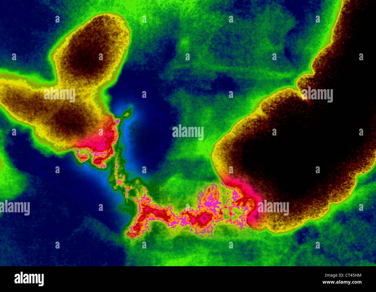 KOLONKARZINOM, X-RAY Stockfoto