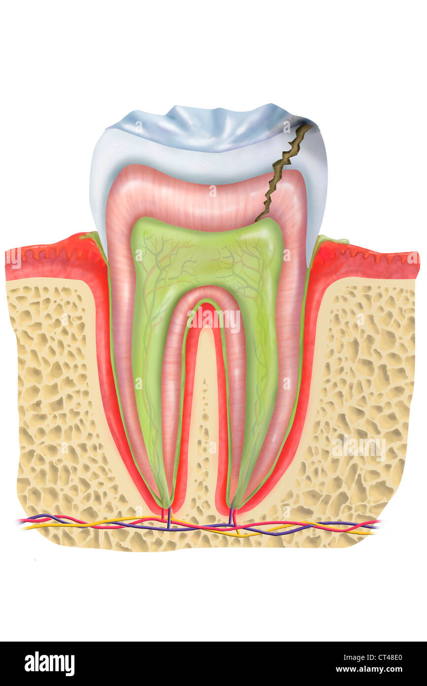 DENTAL CARIE, ZEICHNUNG Stockfoto