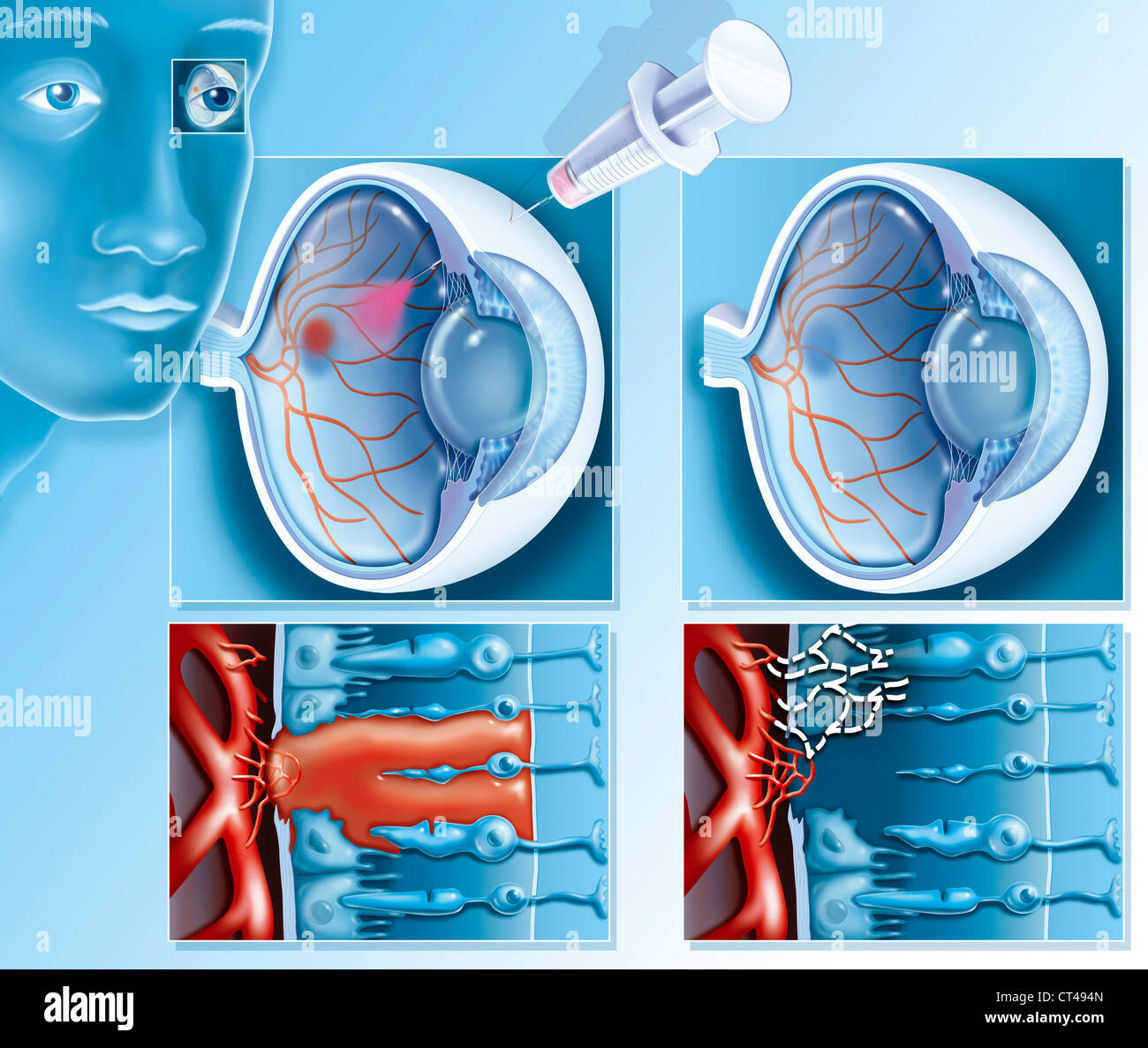 Eye Hemorrhage Stockfotos & Eye Hemorrhage Bilder - Alamy