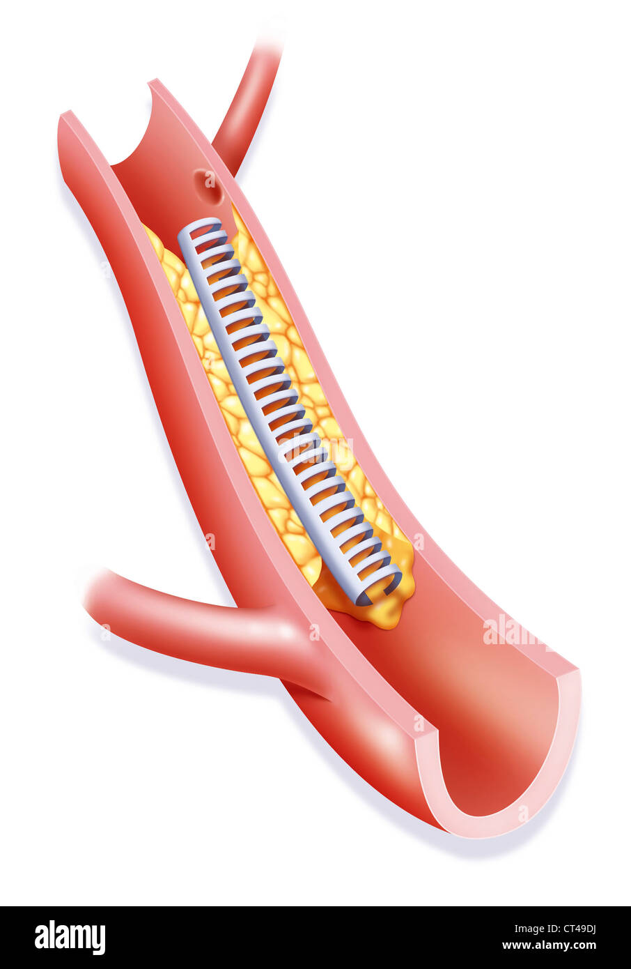 ARTERIELLE ANGIOPLASTIE, ABBILDUNG Stockfotografie Alamy