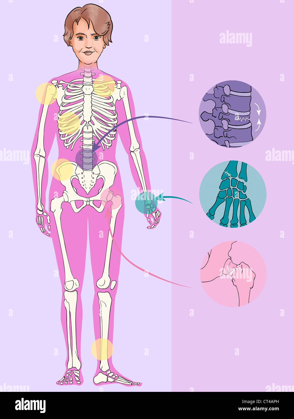 OSTEOPOROSE, ILLUSTRATION Stockfoto