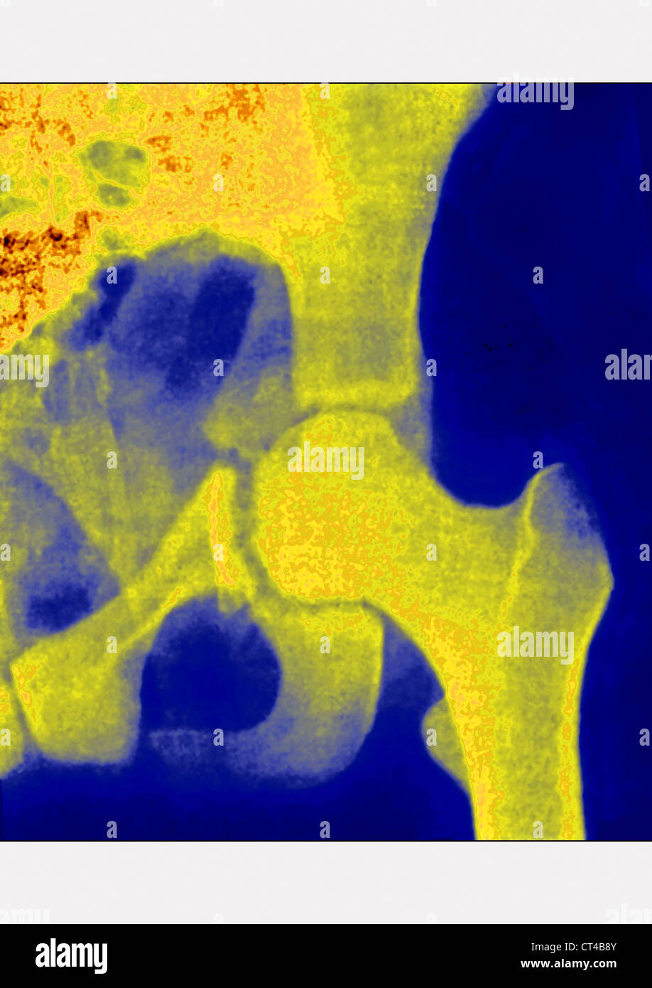 HÜFTFRAKTUR, X-RAY Stockfoto
