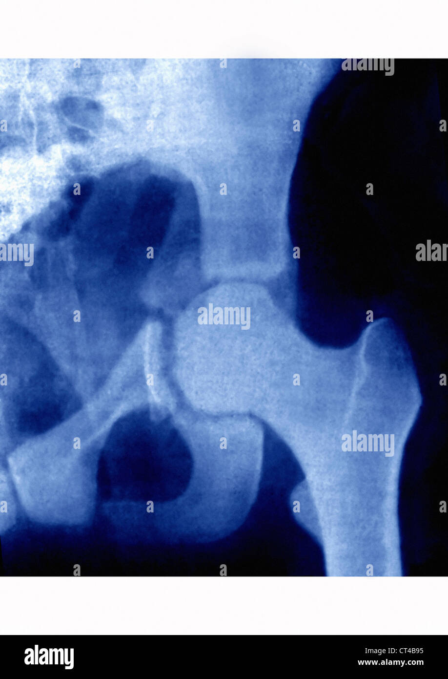 HÜFTFRAKTUR, X-RAY Stockfoto