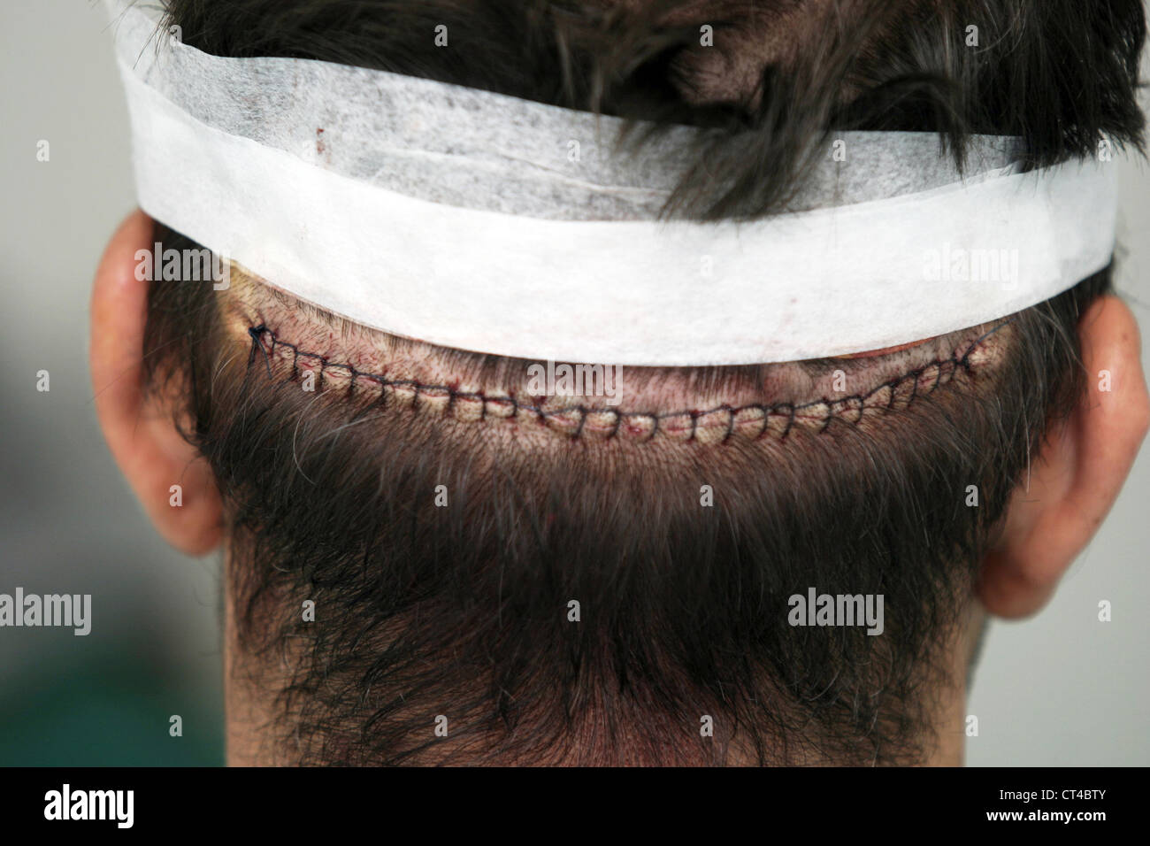 implantat haarchirurgie stockfotografie