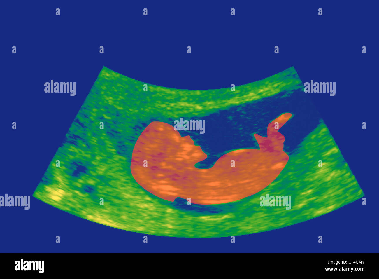 ULTRASCHALL BIOMETRIE DES FÖTUS Stockfoto