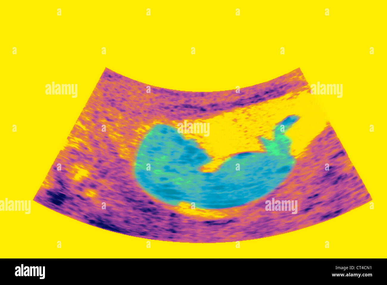 ULTRASCHALL BIOMETRIE DES FÖTUS Stockfoto