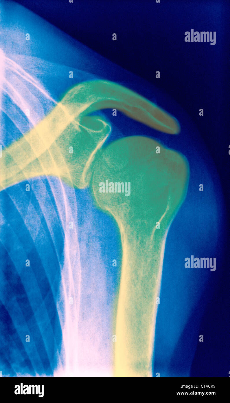 SCHULTER, X-RAY Stockfoto