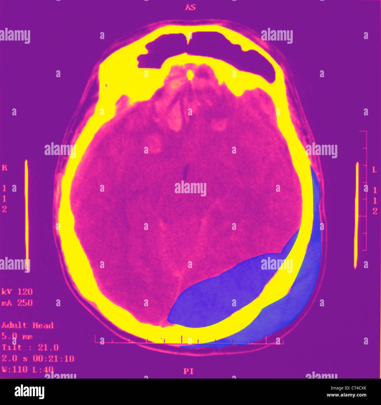 HÄMATOM, GEHIRN-SCAN Stockfoto