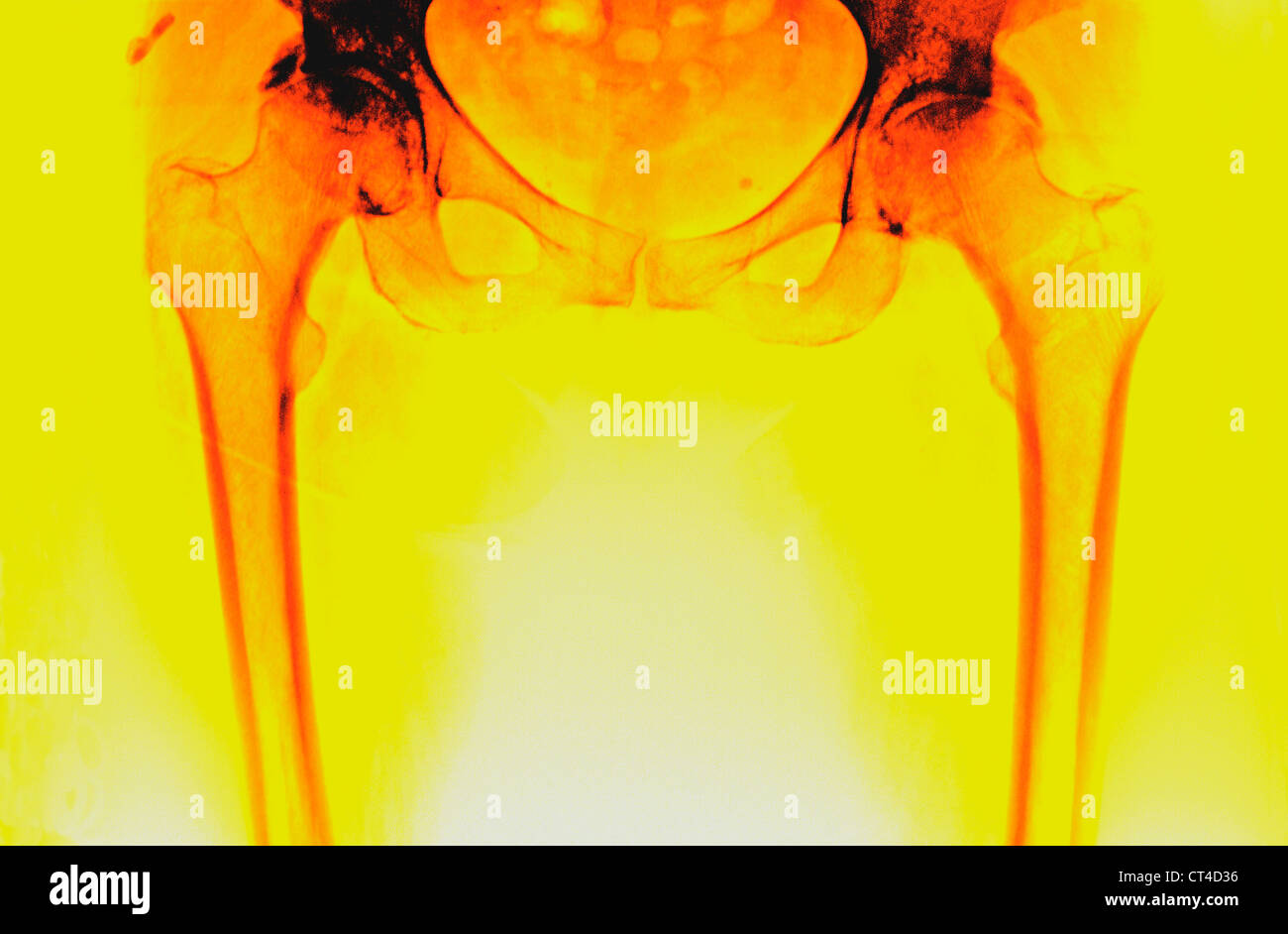 HIP ARTHROSE, X-RAY Stockfoto