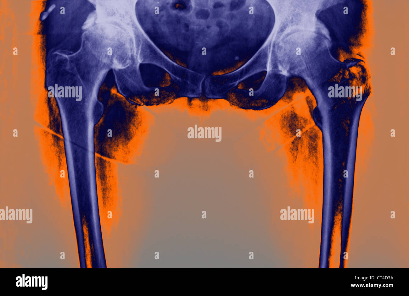HIP ARTHROSE, X-RAY Stockfoto