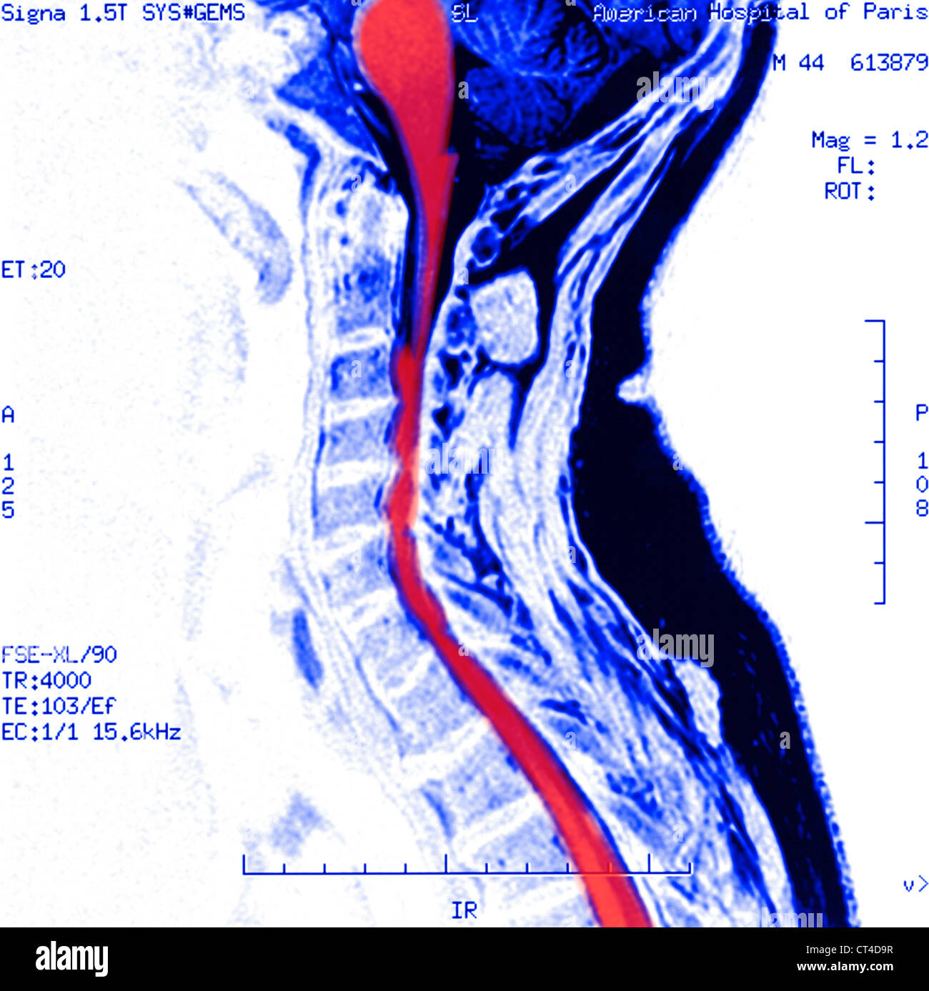 HWS ARTHROSE, MRT Stockfoto