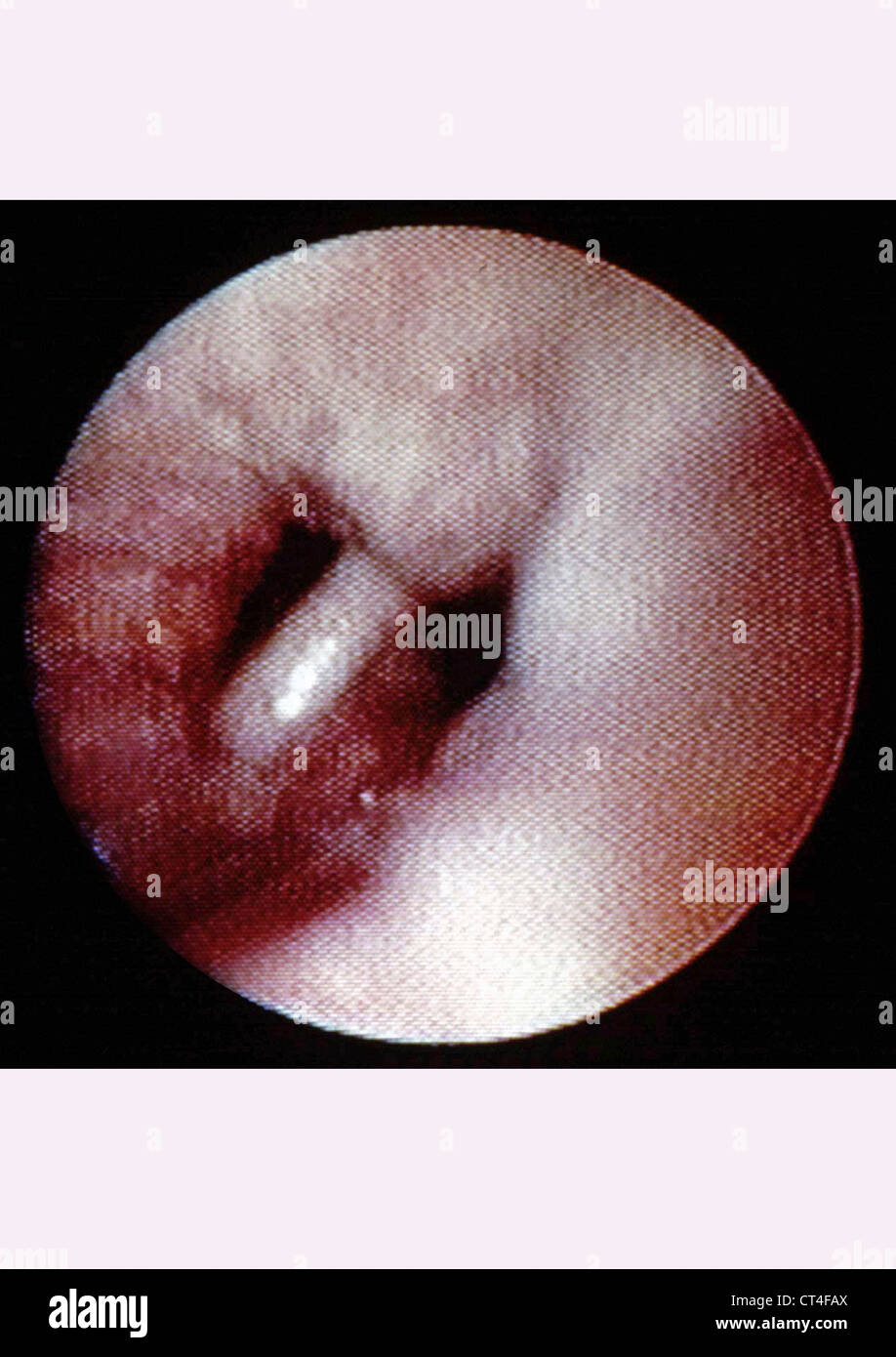 BRONCHIAL-KREBS, ENDOSKOPIE Stockfoto