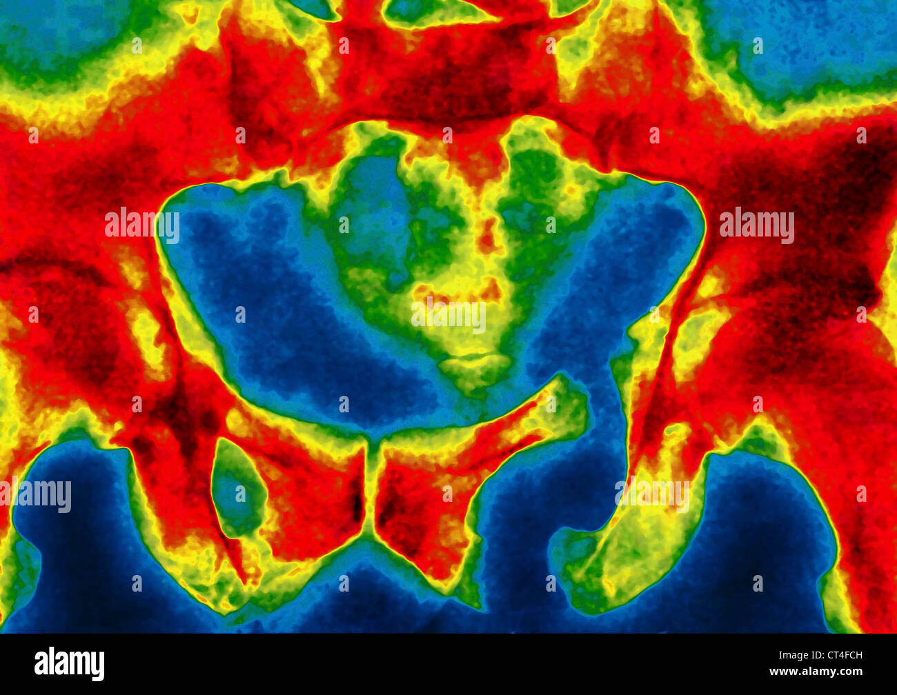 GEBROCHENEN BECKEN, X-RAY Stockfoto