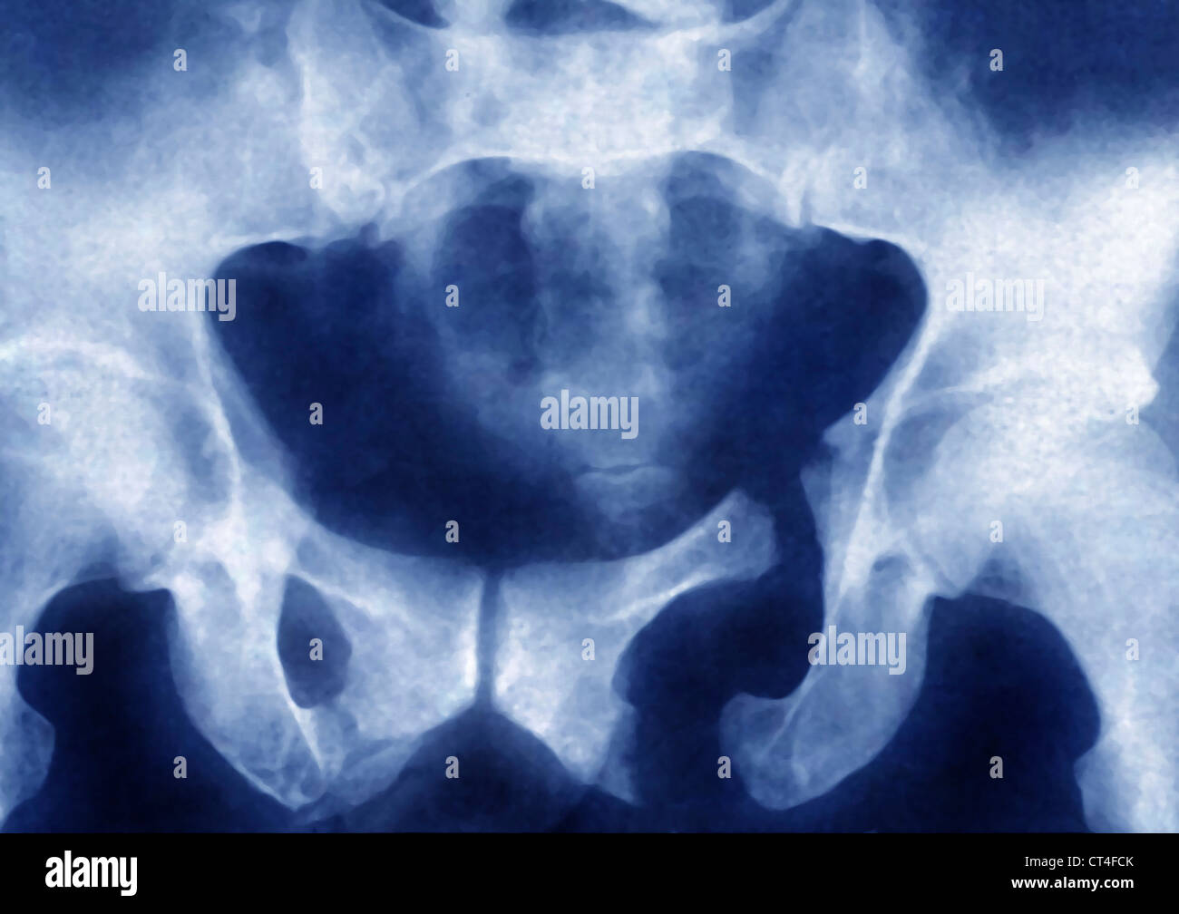 GEBROCHENEN BECKEN, X-RAY Stockfoto