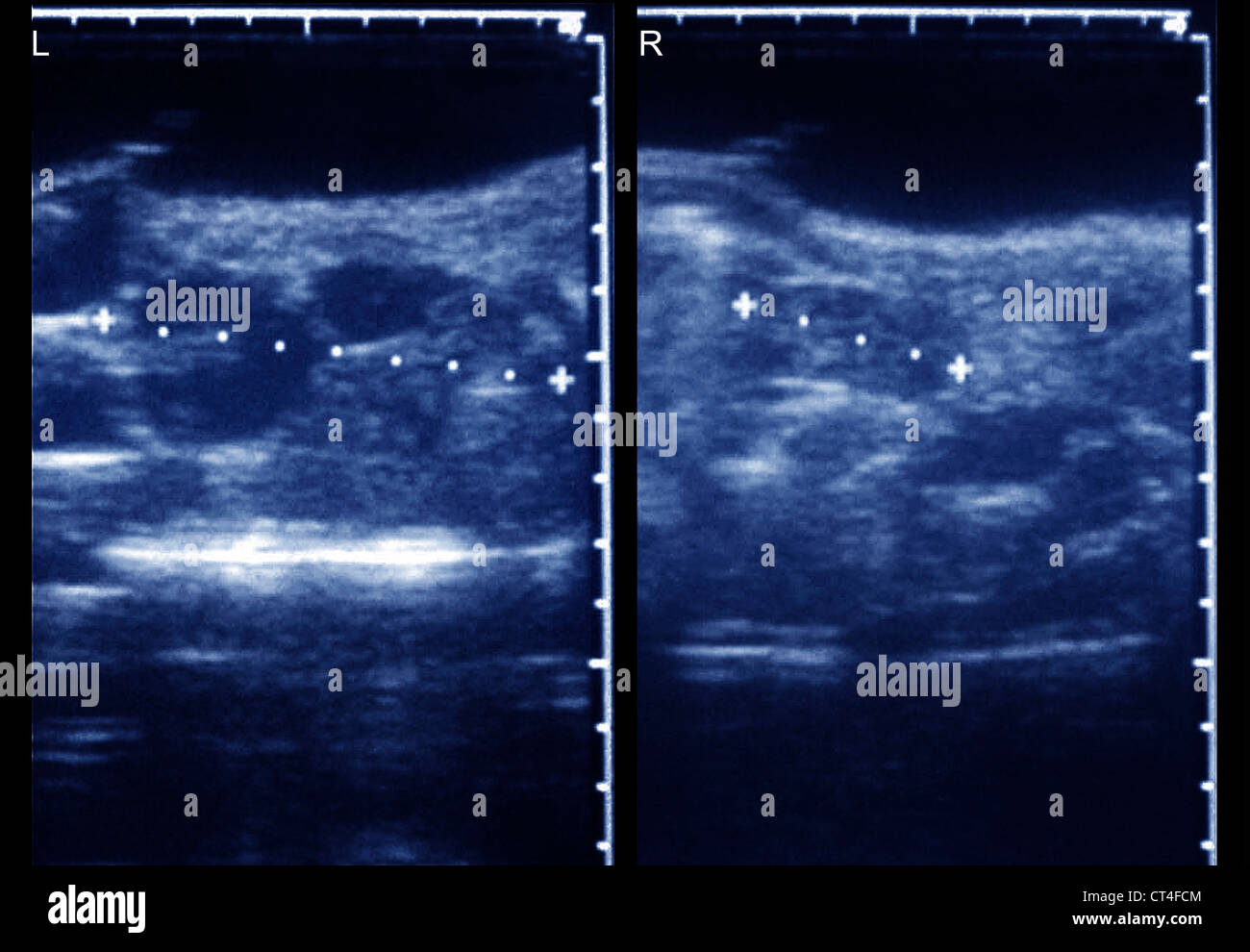 MULTICYSTIC DYSPLASTISCHE NIERE Stockfotografie - Alamy