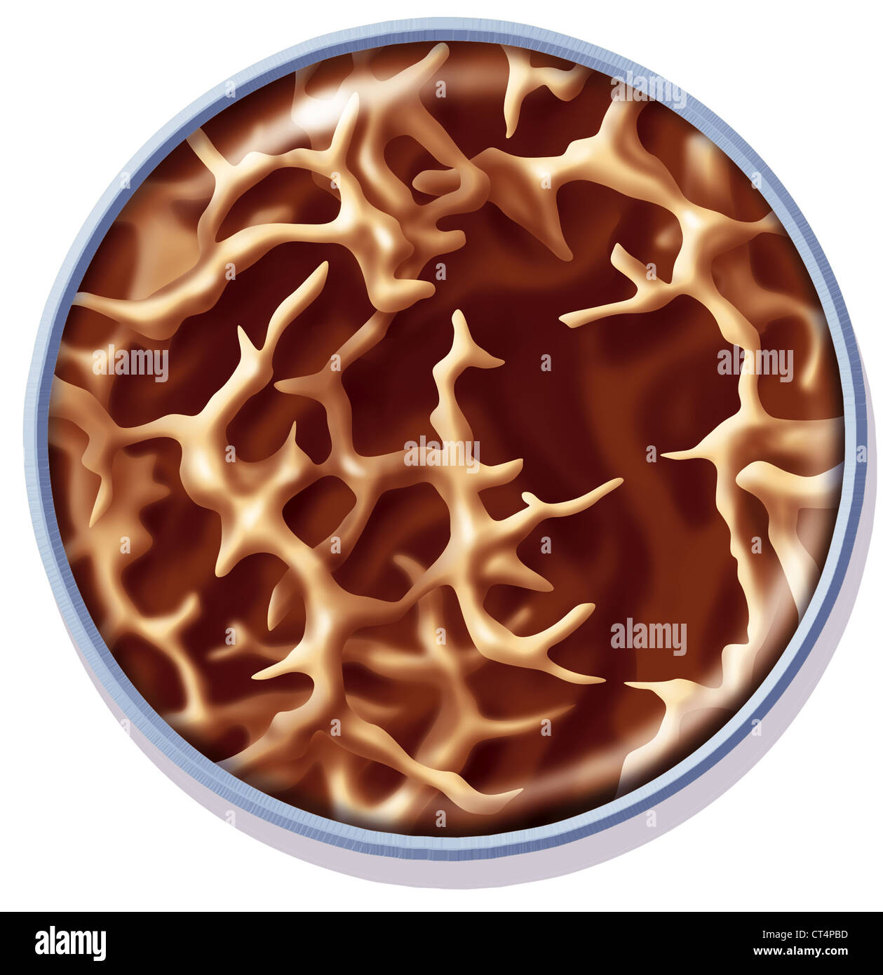 OSTEOPOROSE, ILLUSTRATION Stockfoto