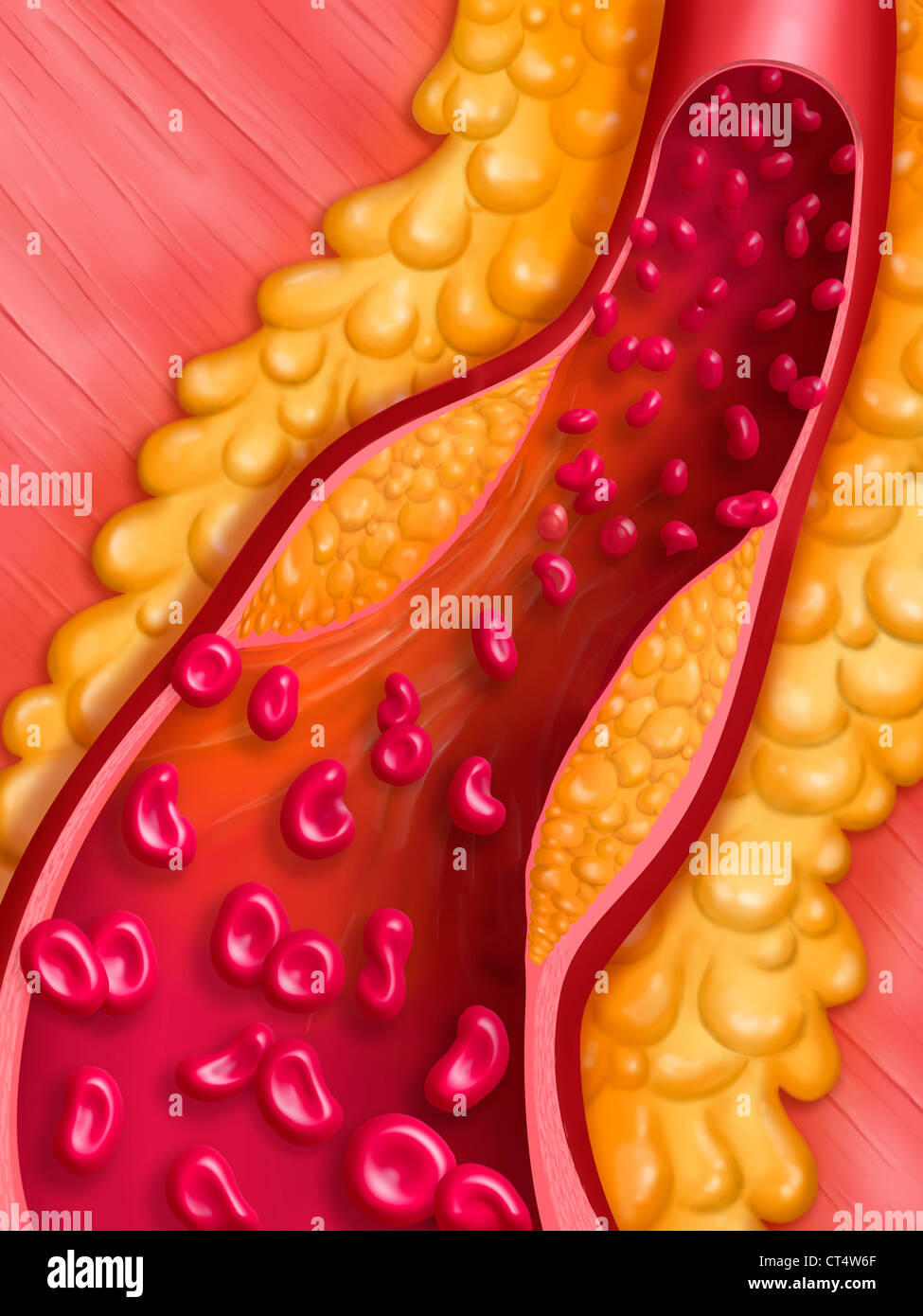 ARTERIELLE ANGIOPLASTIE, ABBILDUNG. Stockfoto