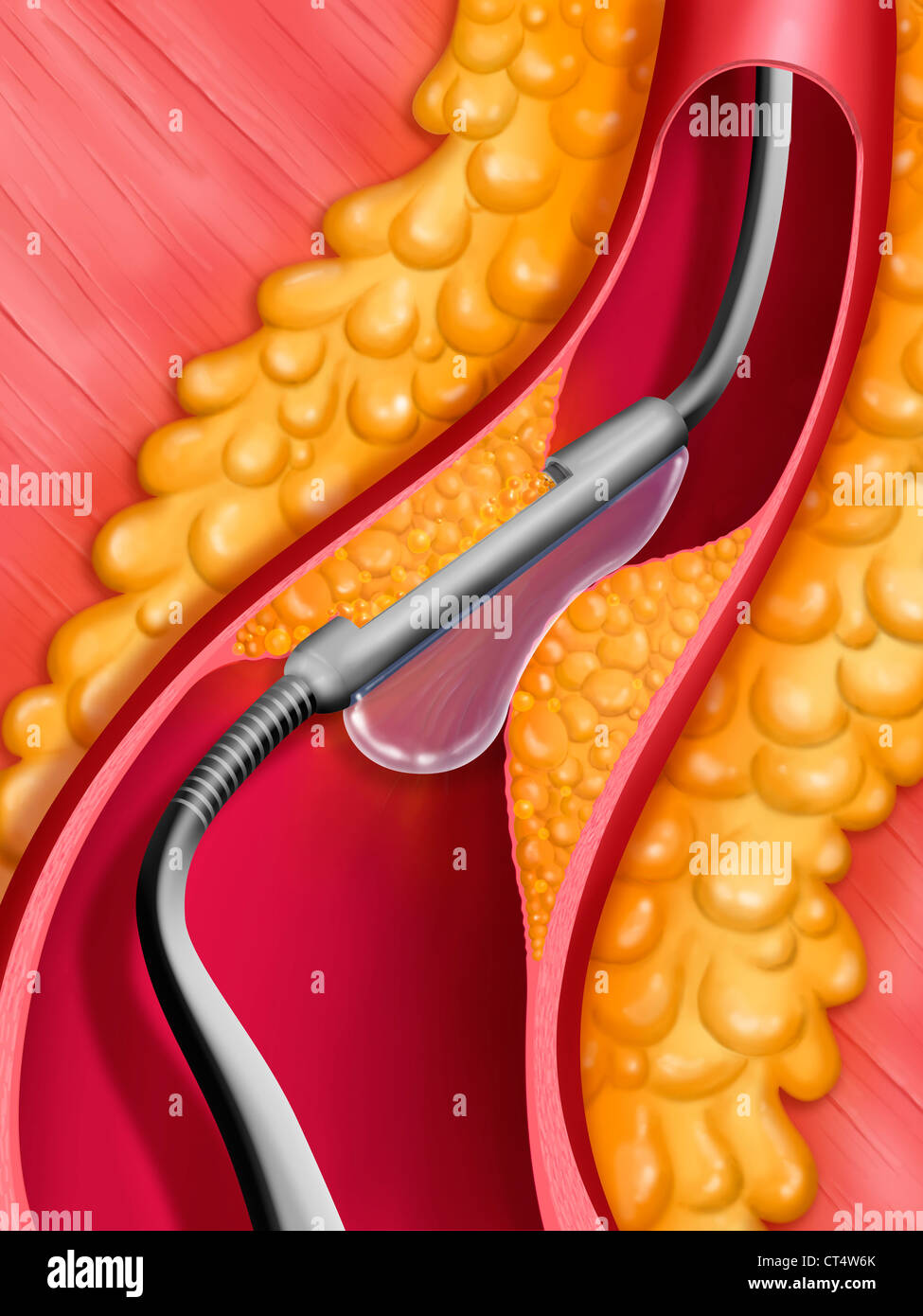 GERICHTETE ATHERECTOMY Stockfoto