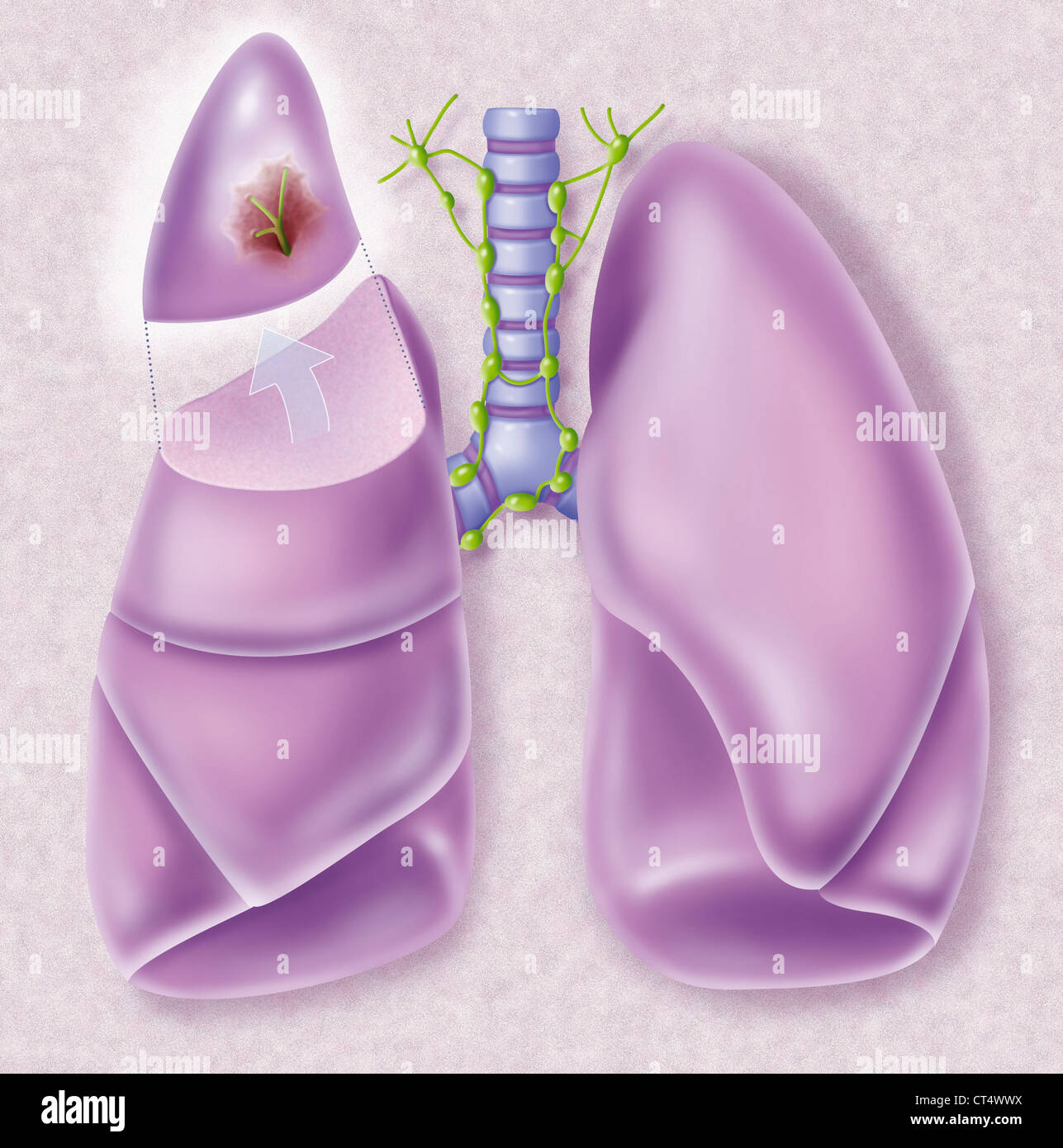 KREBSCHIRURGIE Stockfoto