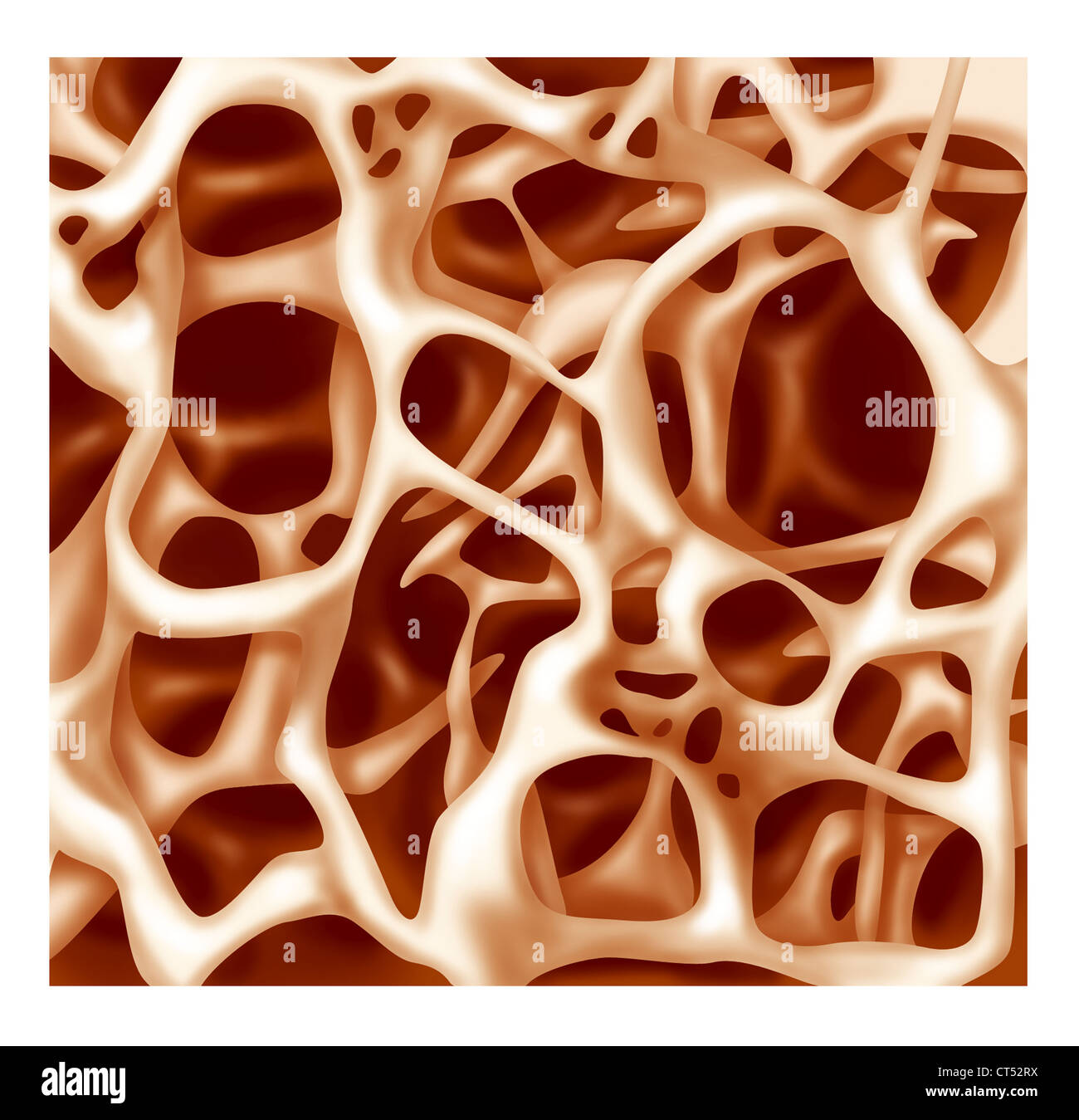 OSTEOPOROSE, ILLUSTRATION Stockfoto