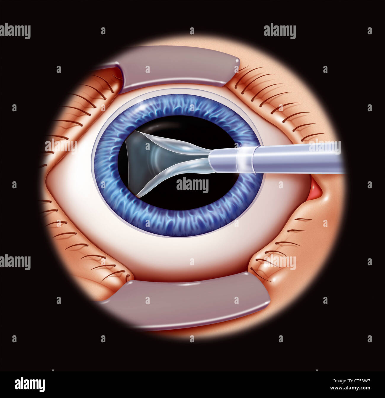 Intraokular Intraocular lens -Fotos und -Bildmaterial in hoher Auflösung – Alamy