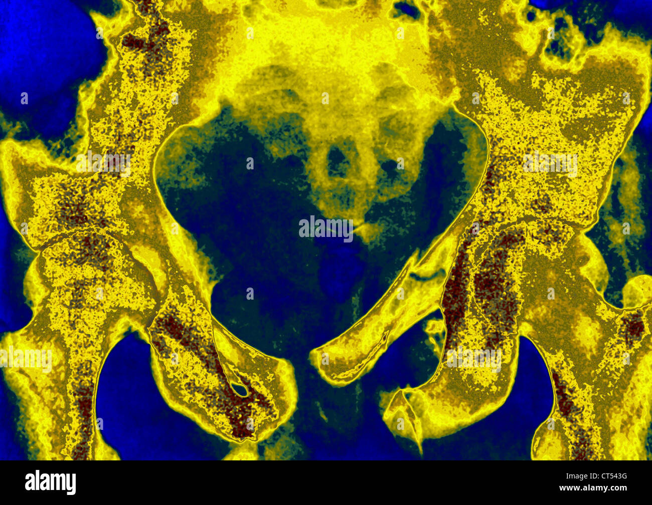 GEBROCHENEN BECKEN, X-RAY Stockfoto