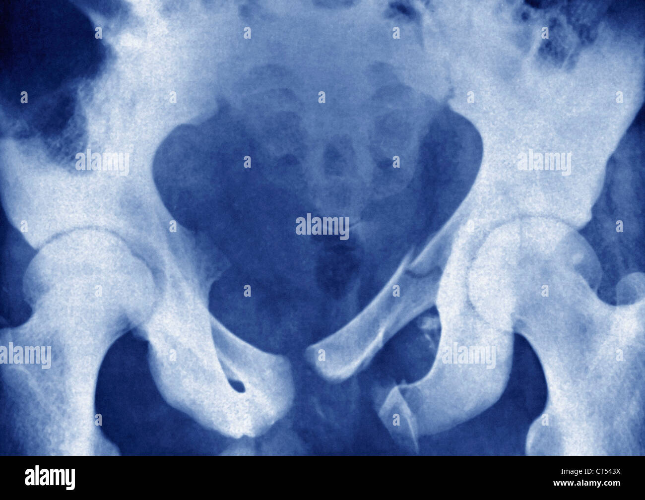 GEBROCHENEN BECKEN, X-RAY Stockfoto
