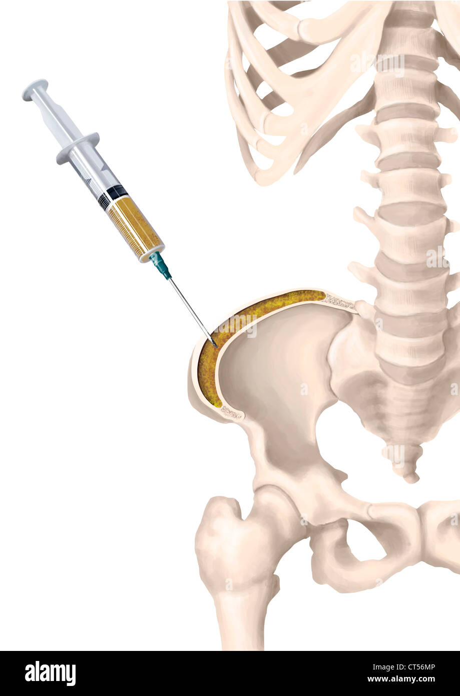 KNOCHENMARKASPIRATION Stockfoto