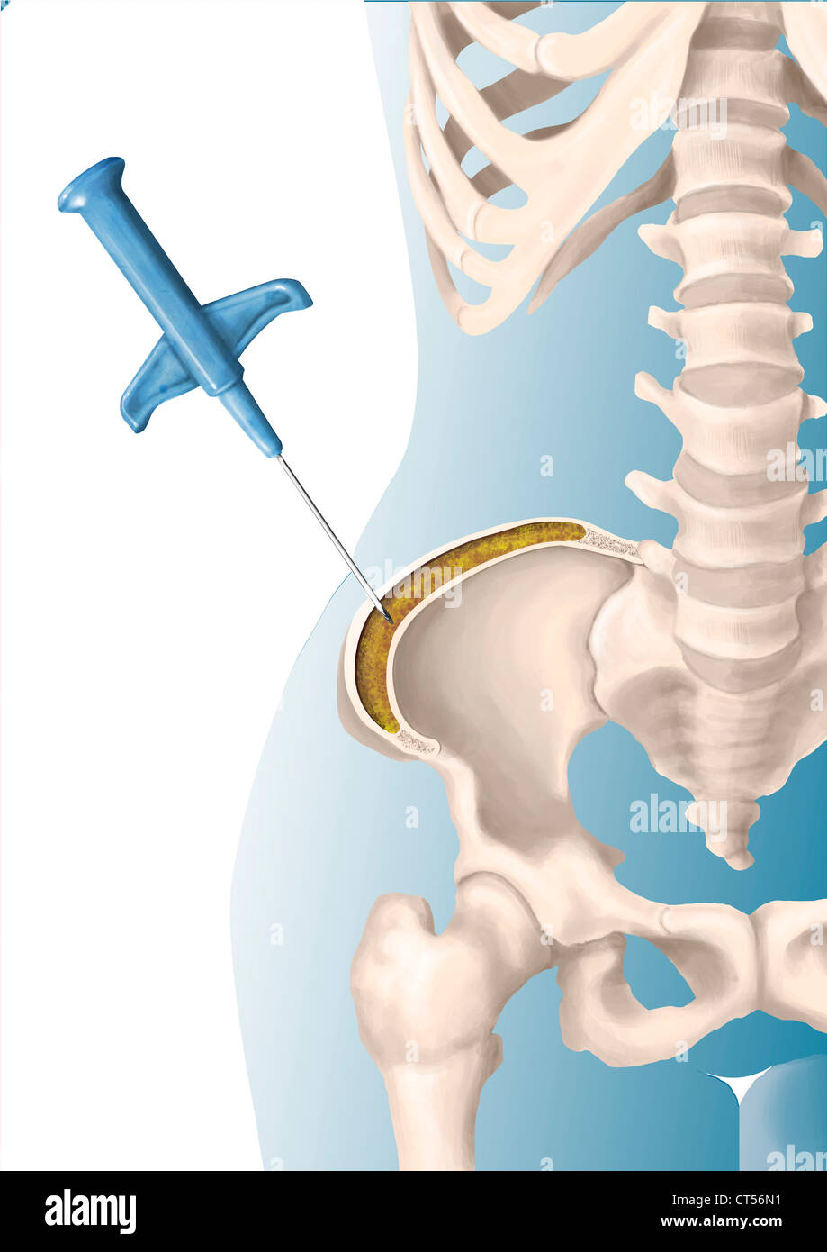 KNOCHENMARKASPIRATION Stockfoto