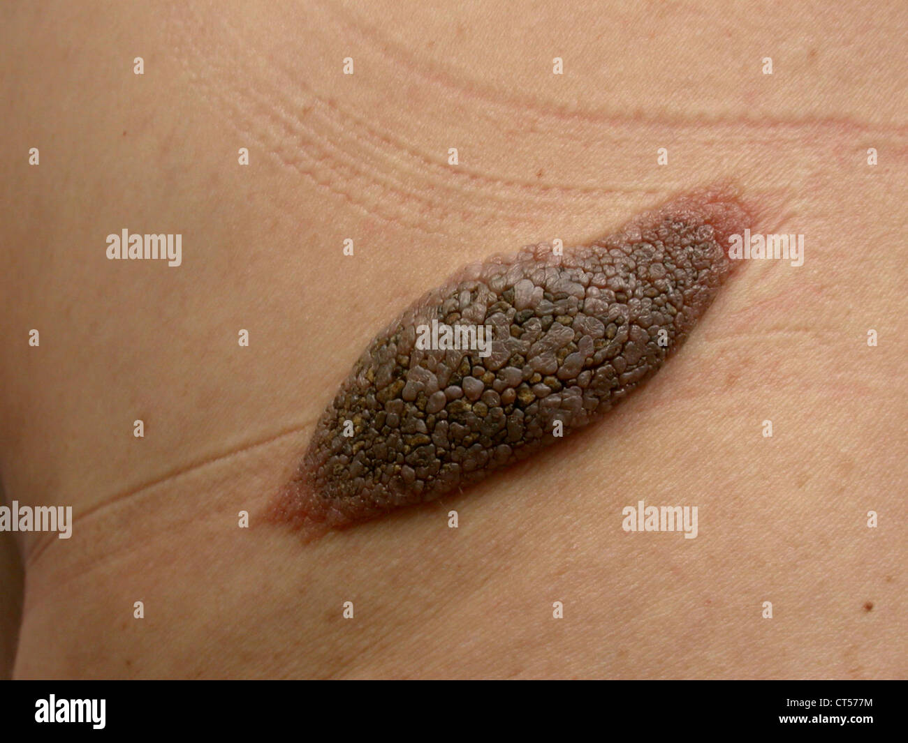 SEBORRHOISCHE KERATOSE Stockfoto