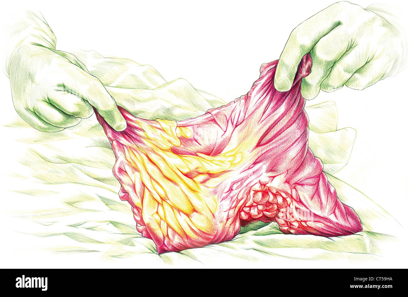 DICKDARMOPERATION Stockfoto