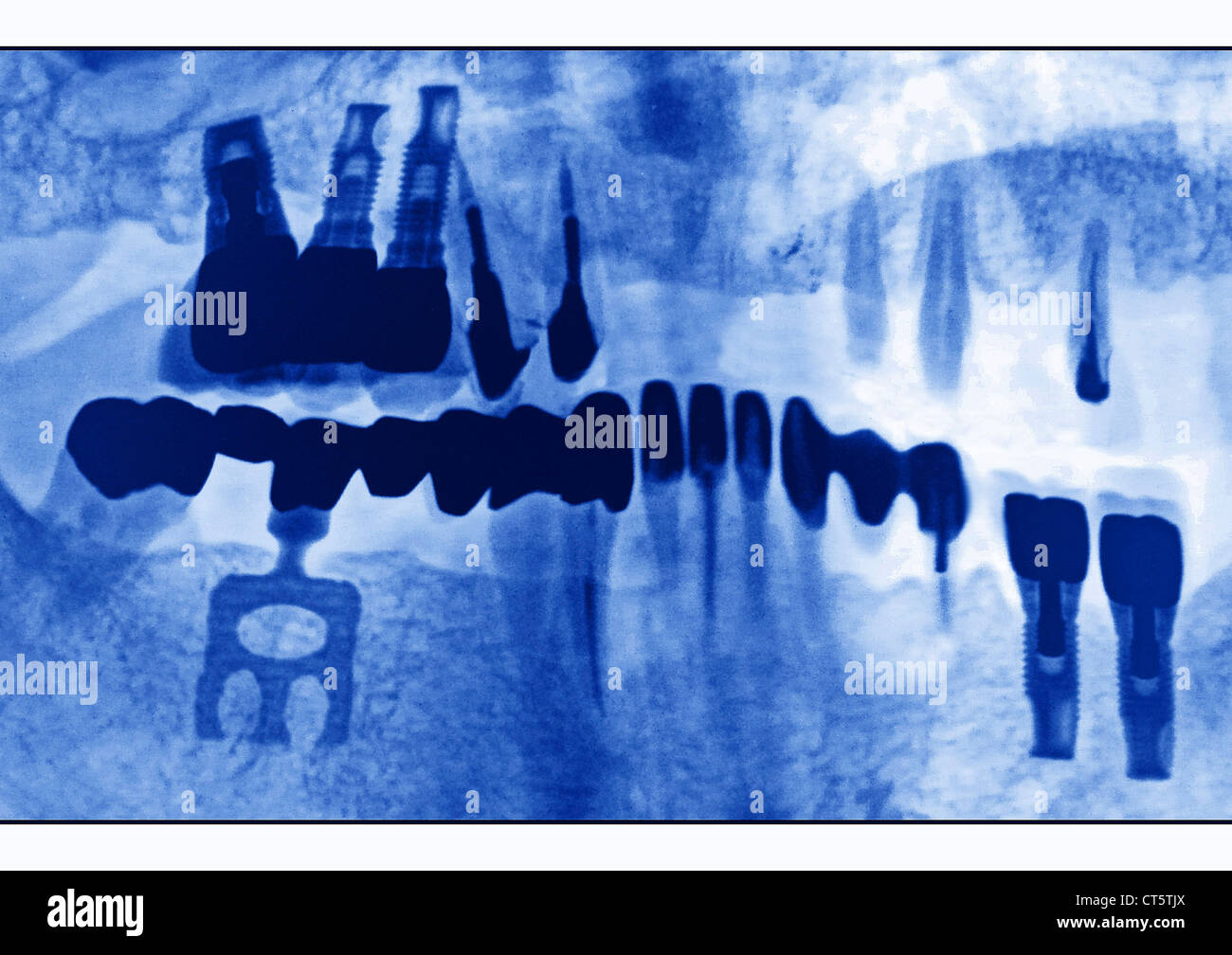 ZAHNIMPLANTAT, X-RAY Stockfoto