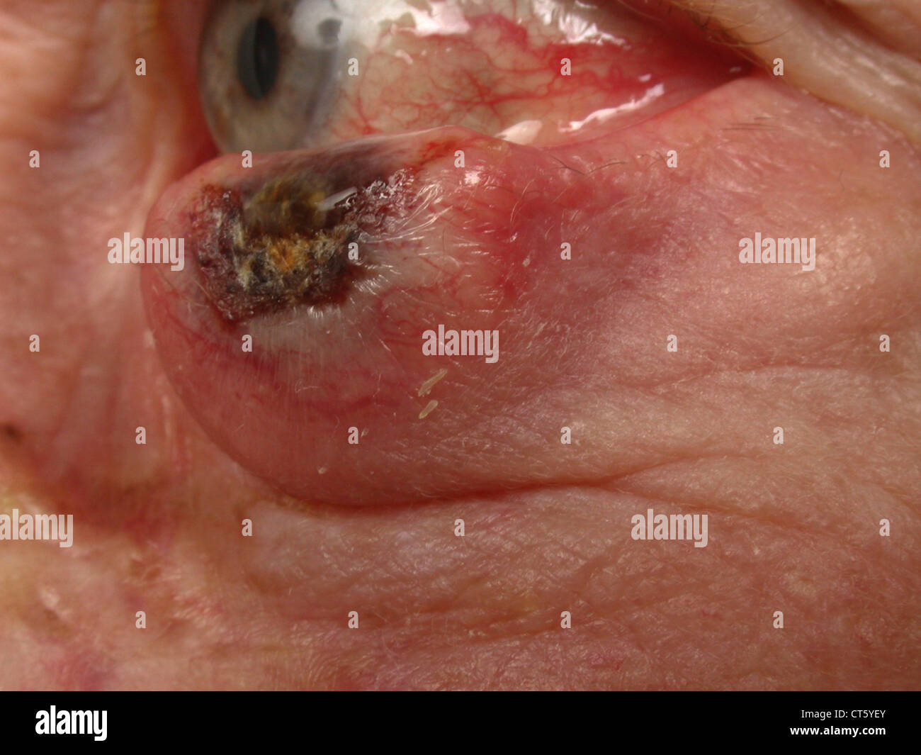 BÖSARTIGER TUMOR DER HAUT Stockfoto