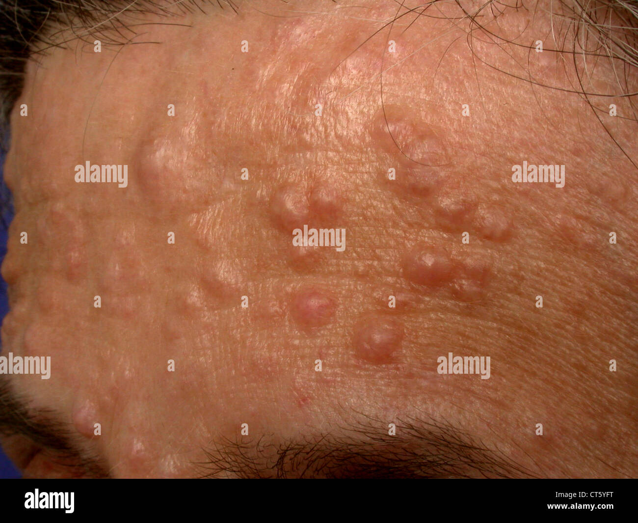 Seltene Hautkrankheit Stockfotos und bilder Kaufen Alamy