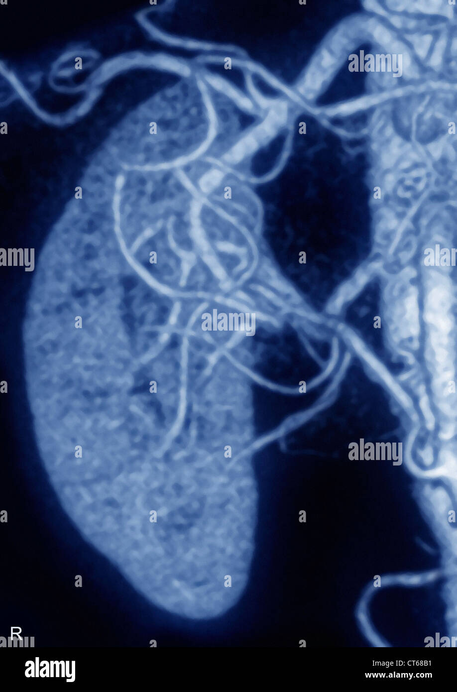 NIEREN-ARTERIE, 3D-SCAN Stockfoto