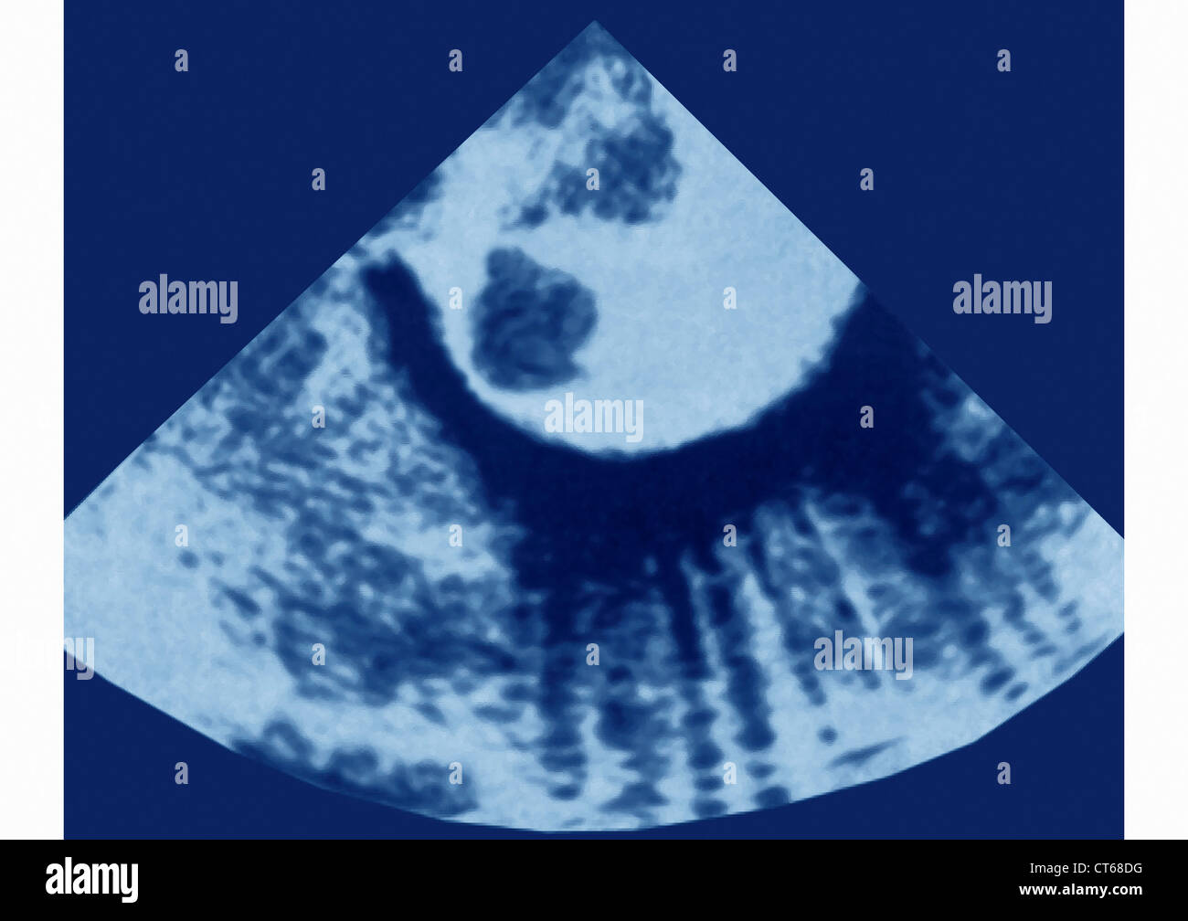 AORTA THROMBUS, SONOGRAPHIE Stockfotografie - Alamy