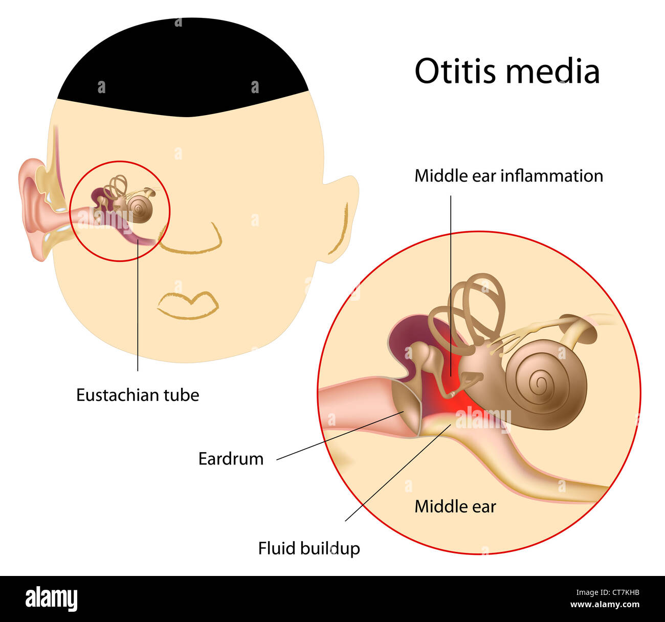 Otitis media Stockfoto