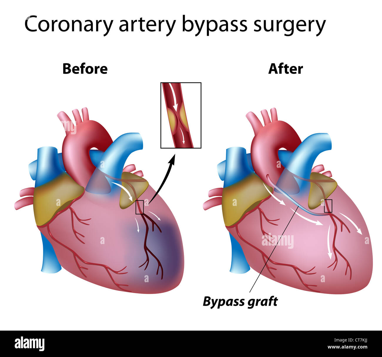 Coronary artery bypass graft stockfotos coronary artery bypass graft
