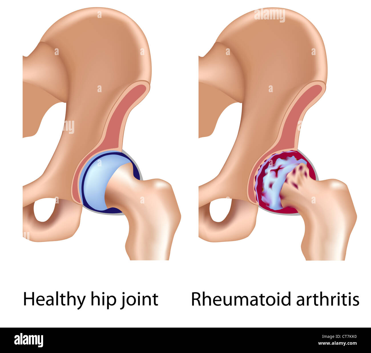 Rheumatoide Arthritis des Hüftgelenks Stockfoto