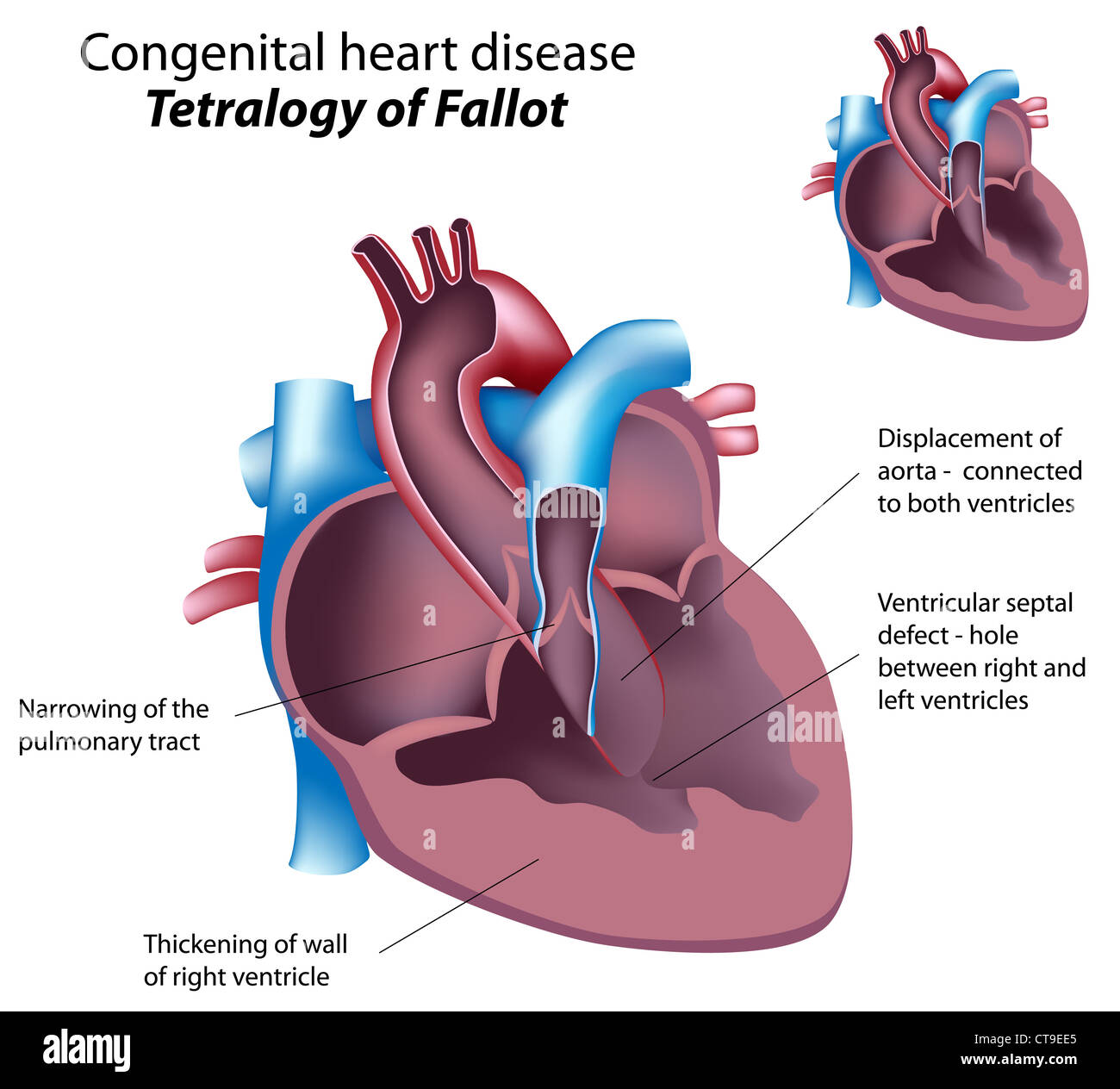 Angeborene Herzfehler: Tetralogie von Fallot Stockfoto