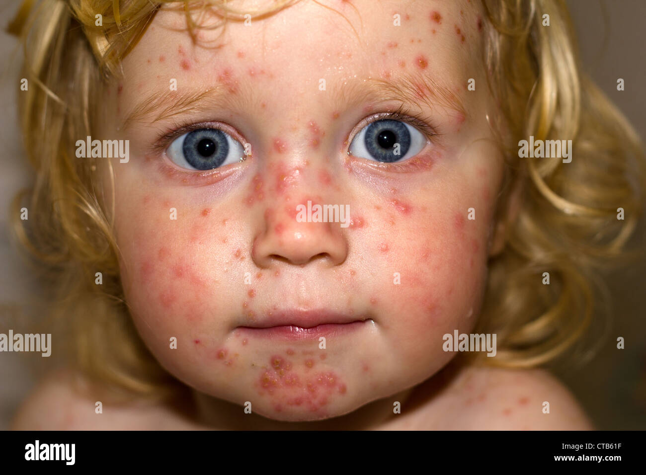 Ein und eine Hälfte Jahr alt Mädchen leiden mit Windpocken Flecken im Gesicht Stockfoto